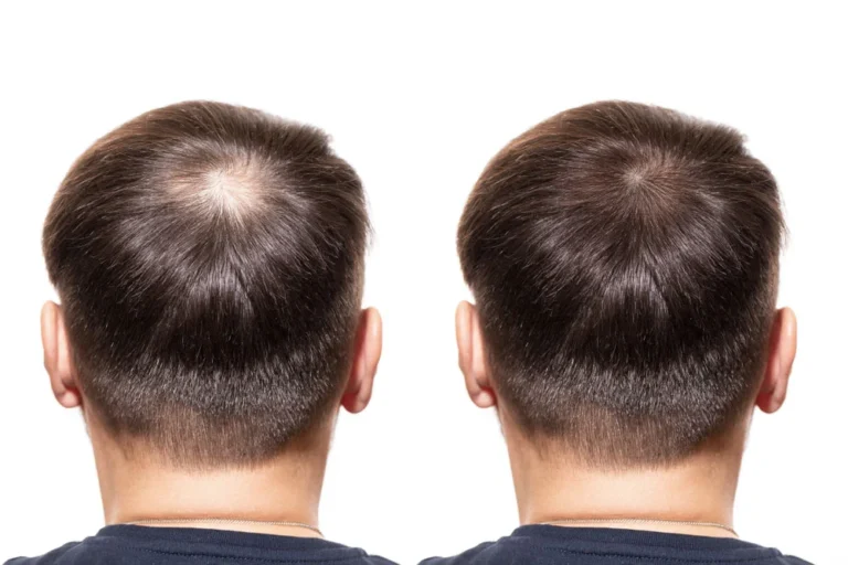 PRP Therapy and Hair Transplants: The Perfect Duo for Hair Restoration